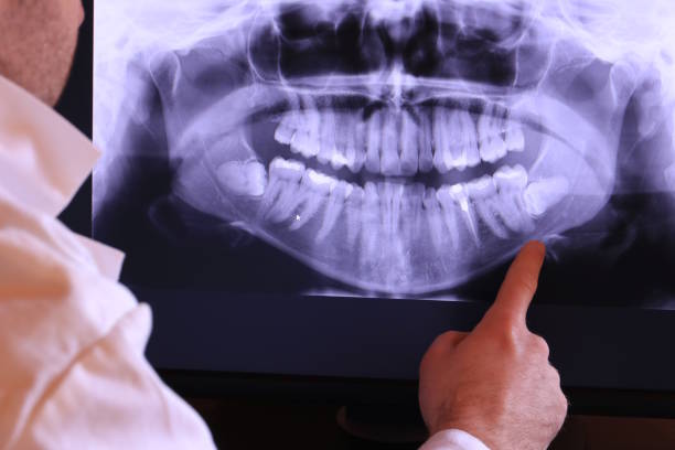 Best Knocked-Out Tooth (Avulsed Tooth) Treatment in Speer, NC